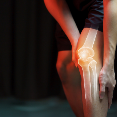Imagen de un hombre sosteniendo su rodilla, con un efecto de rayos X que muestra la estructura ósea de la articulación. La imagen ilustra el dolor en la rodilla, destacando la anatomía del fémur, la tibia y la rótula. Este recurso visual es útil para temas relacionados con lesiones deportivas, fisioterapia y salud articular.