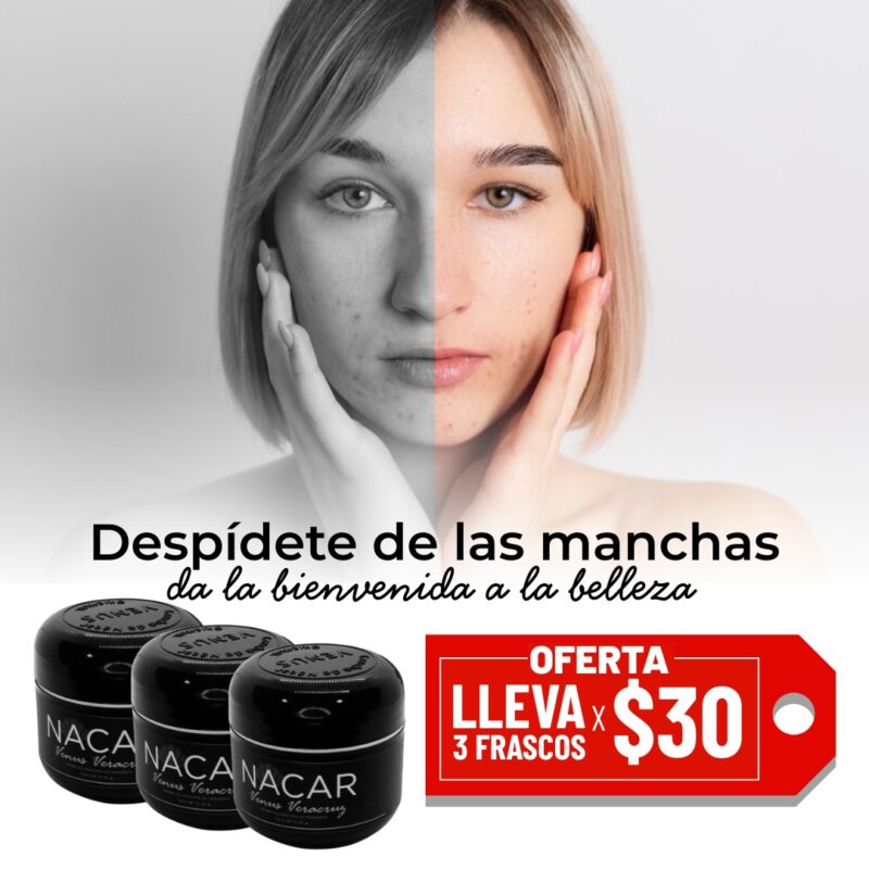 Imagen que muestra el antes y después de una mujer que utiliza productos de la marca Nacar para eliminar manchas en la piel. Se destacan tres frascos del producto y una oferta de tres frascos por $30.