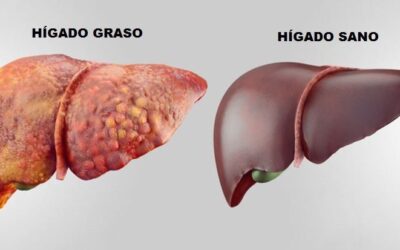 Hígado graso: cómo se forma, riesgos y cómo sanarlo de forma natural