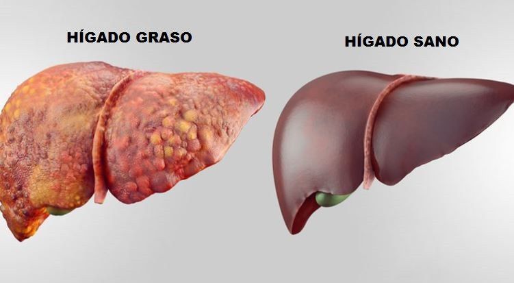 Hígado graso: cómo se forma, riesgos y cómo sanarlo de forma natural